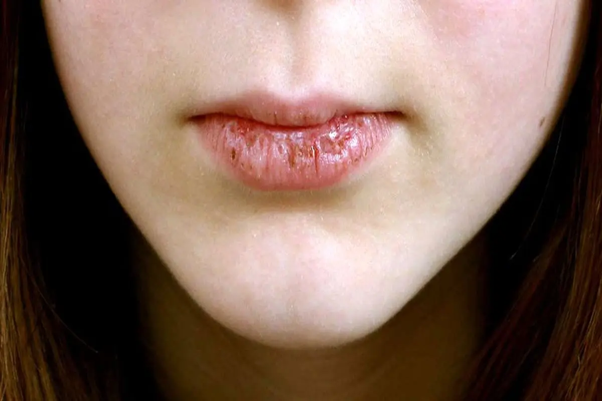 چرا دهان خشک می شود؟ آشنایی با علل بروز و مسیر درمان