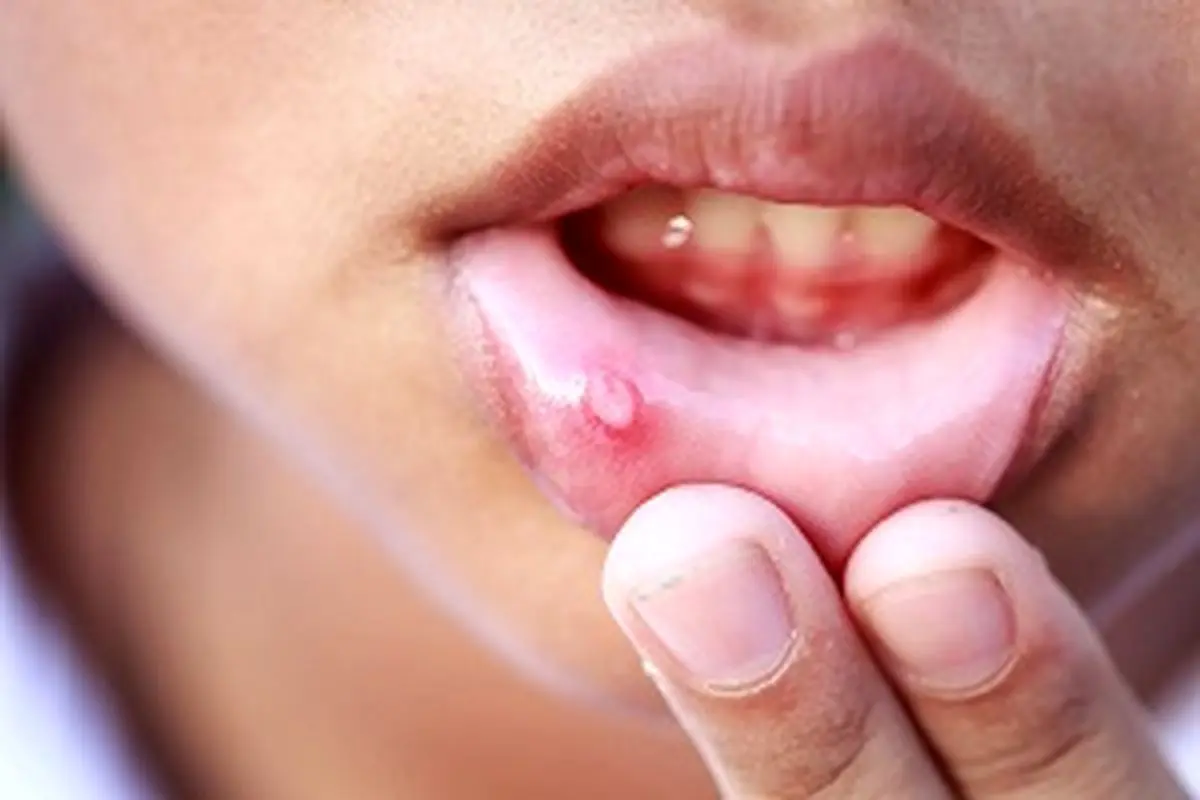 درمان خانگی زخم های دهانی