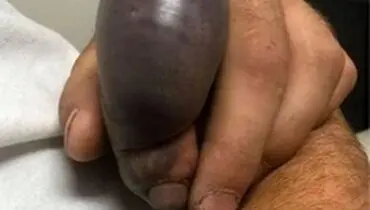 نیش مار، انگشت یک مرد را چند برابر کرد +عکس