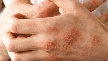 این بیماری پوستی دردسرساز است!