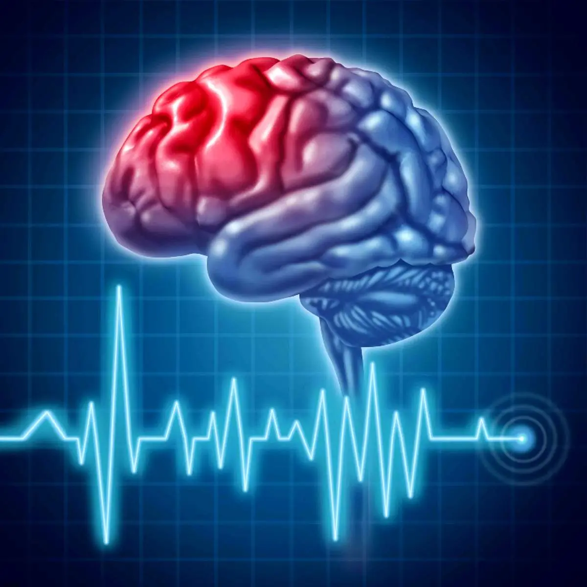 شایعترین علل بروز سکته مغزی