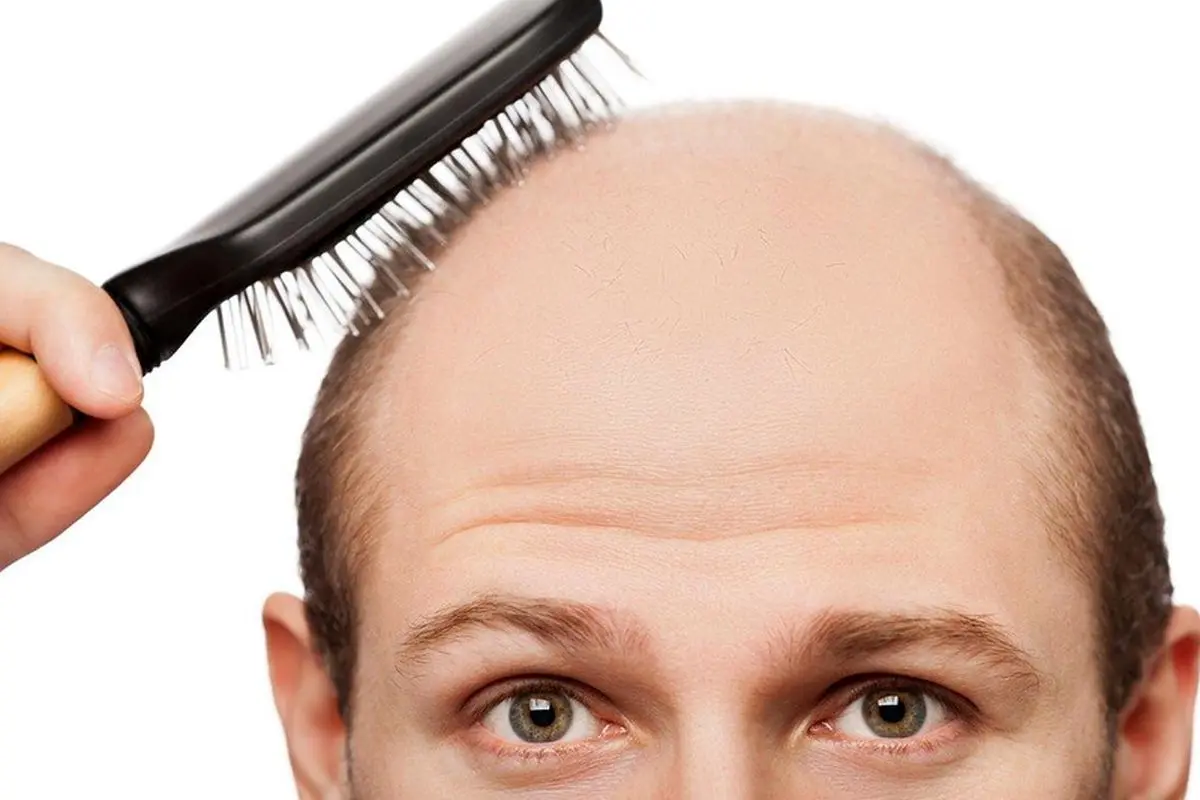 راهکارهای درمانی برای ریزش مو در آقایان