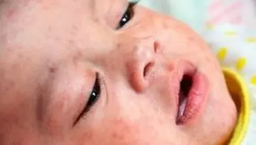 افزایش ۳ برابری مبتلایان به سرخک در جهان