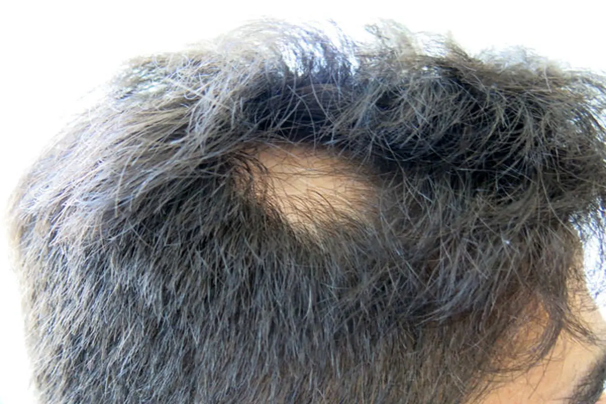 علت اصلی ریزش موی سکه‌ای