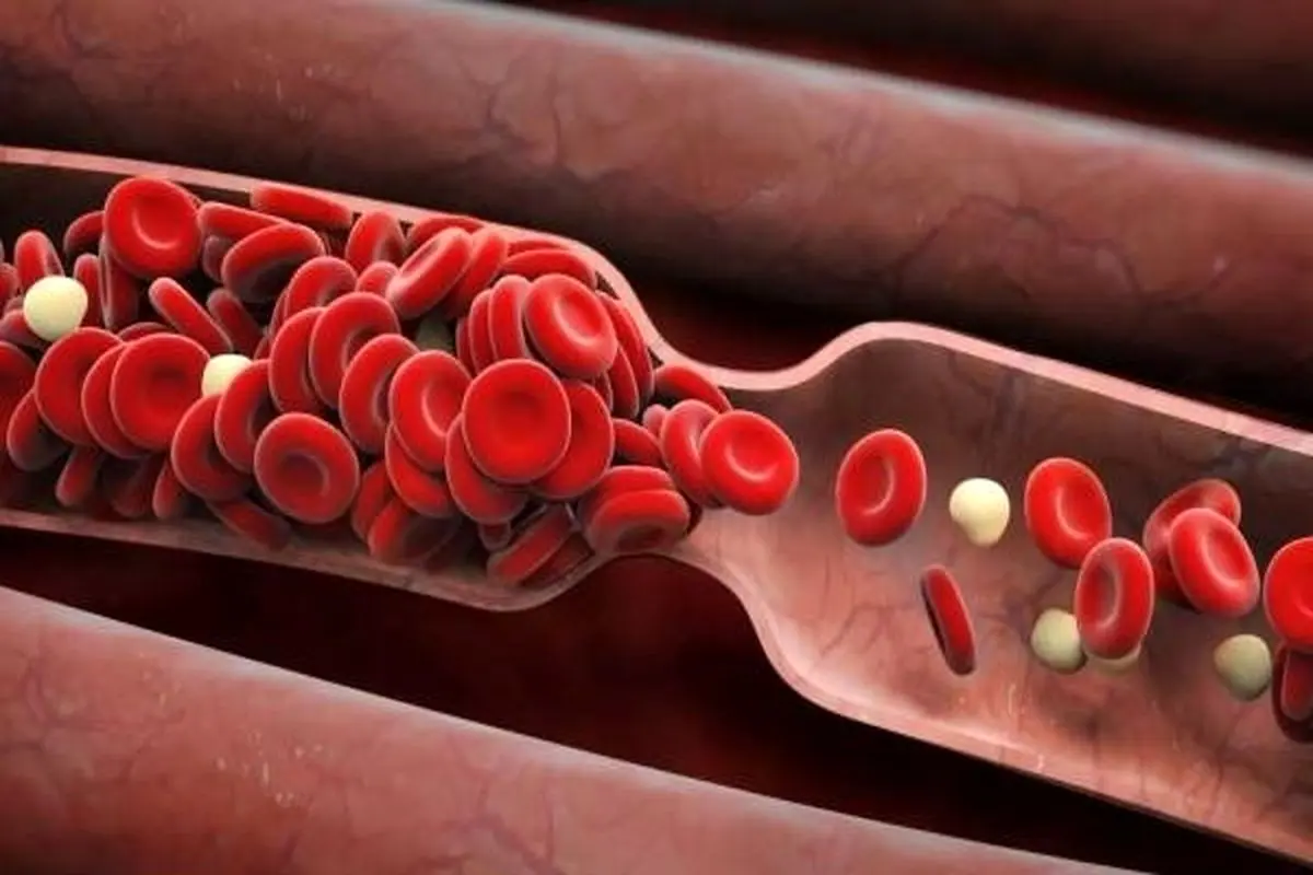 لخته شدن خون چه کسانی را تهدید می‌کند؟