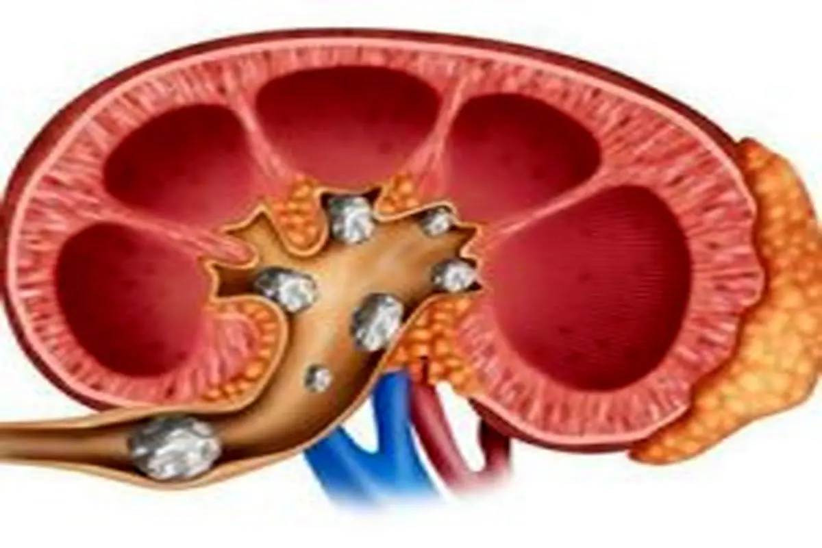 چه افرادی دچار «سنگ کلیه» می‌شوند؟