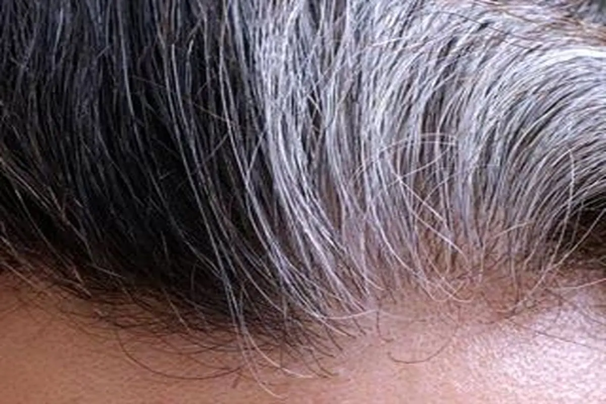 تشخیص ۵ بیماری پنهان، از ظاهر مو‌ها