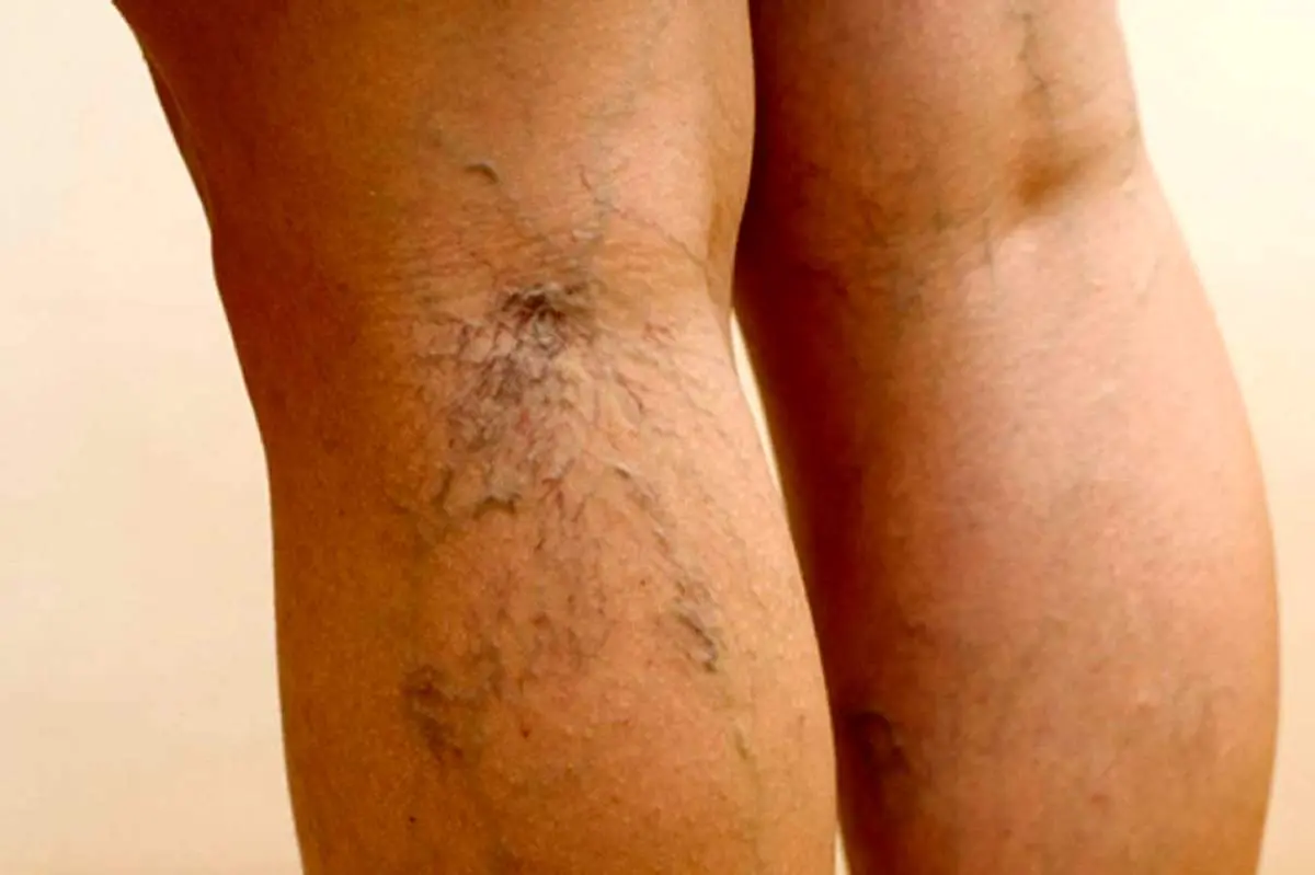 با چه روش‌هایی واریس را درمان کنیم؟