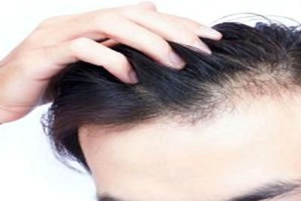 مردانی که دچار ریزش مو هستند، بخوانند