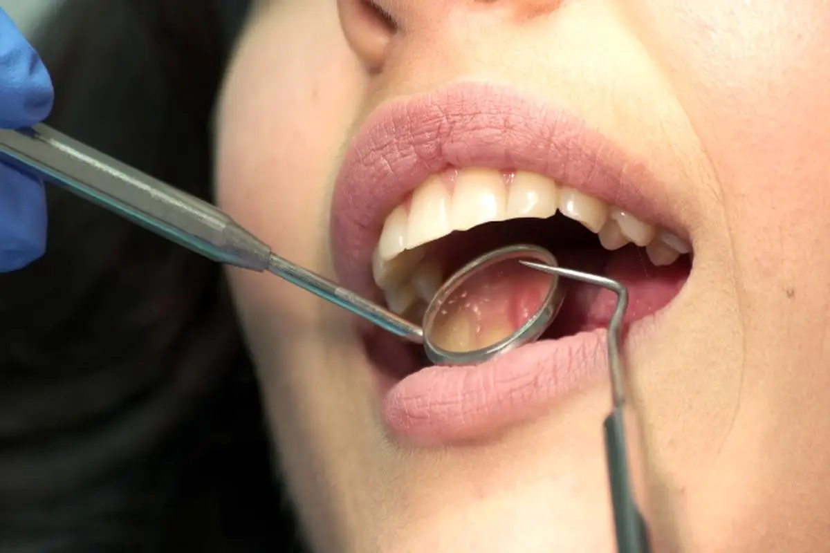 ظاهر شدن لکه‌های سفید روی دندان چه دلایلی دارد؟