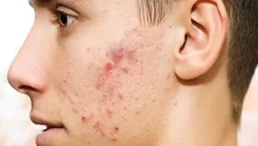 چگونه جای جوش را از بین ببریم؟