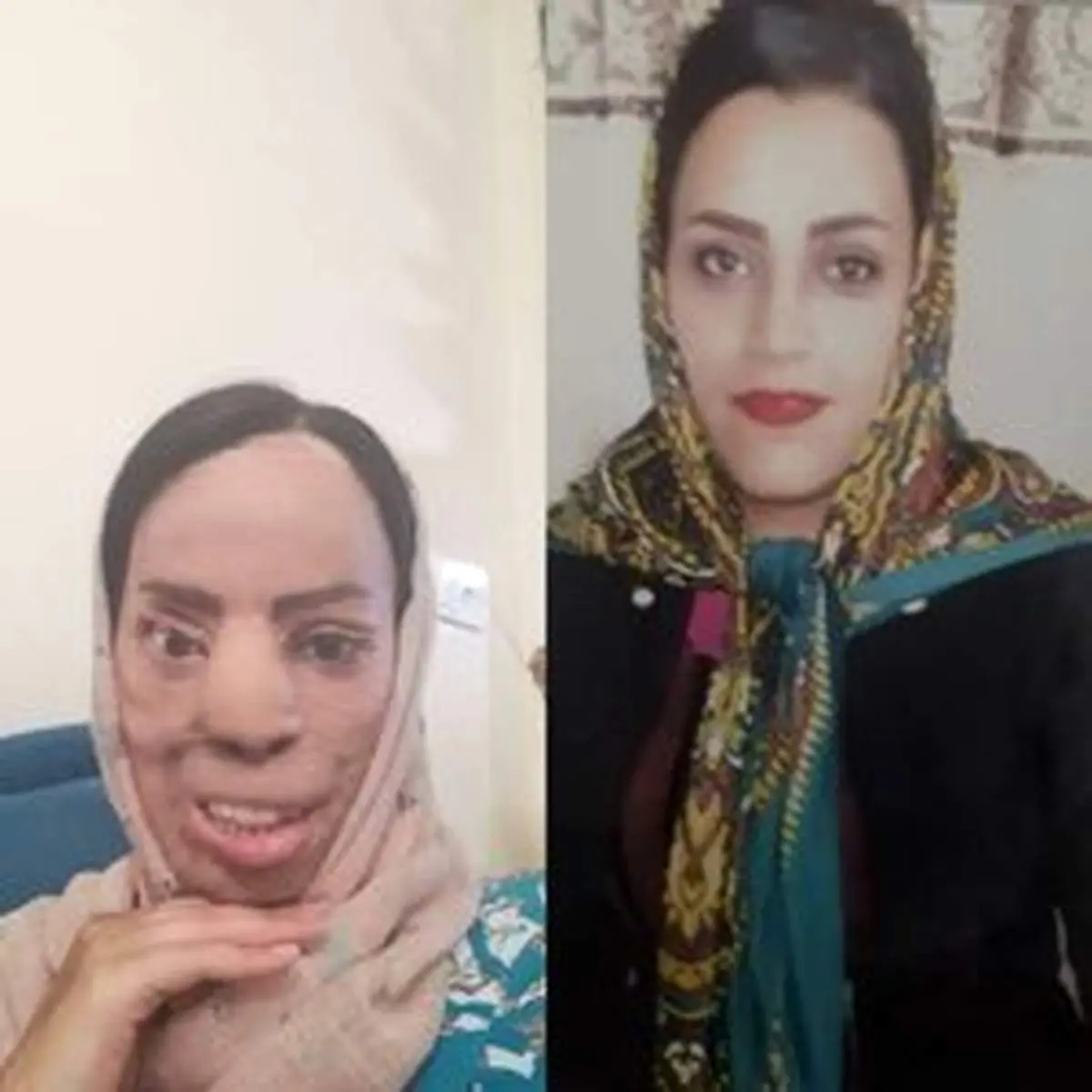 حبس و پرداخت دیه برای عروس اسیدپاش/ قصاص منتفی شد