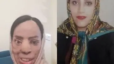 حبس و پرداخت دیه برای عروس اسیدپاش/ قصاص منتفی شد