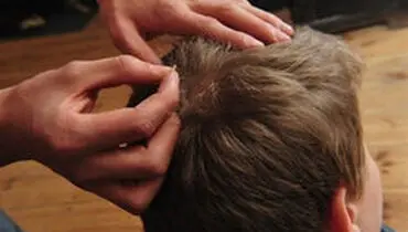 شپش سر و درمان‌های رایج آن/چگونه شپش منتقل می‌شود؟