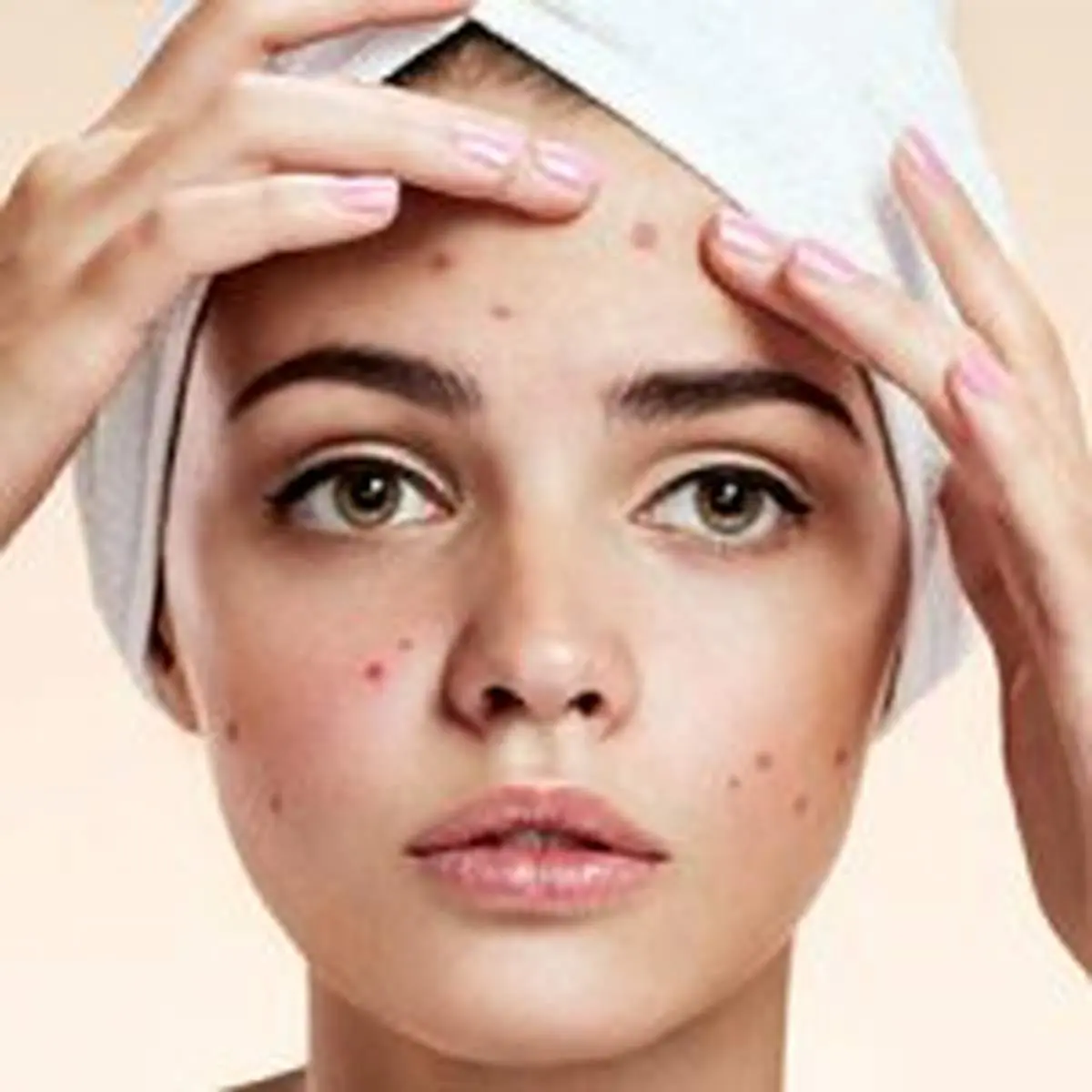 علتهای عجیب آکنه در بزرگسالان و پیشگیری از آن