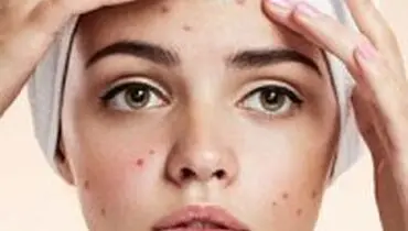 علت‌های عجیب آکنه در بزرگسالان و پیشگیری از آن