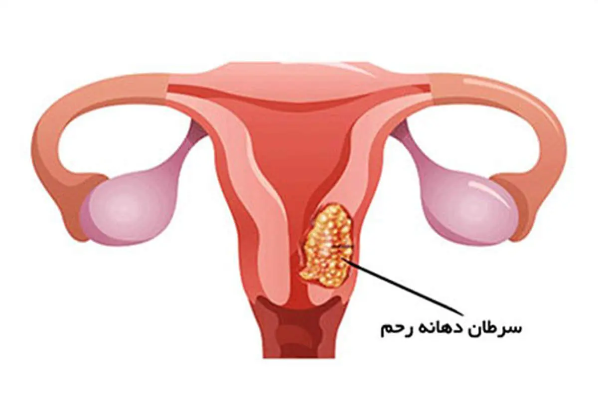 سرطان سرویکس یا سرطان دهانه رحم چیست؟