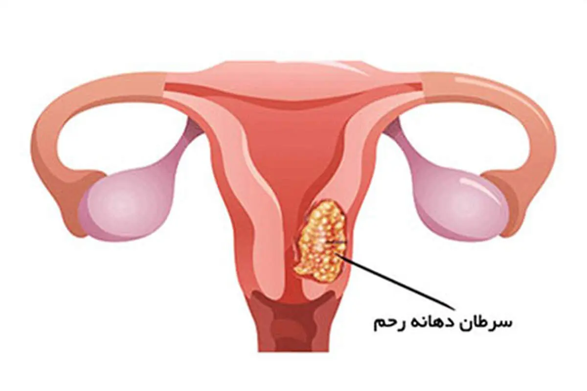 سرطان سرویکس یا سرطان دهانه رحم چیست؟