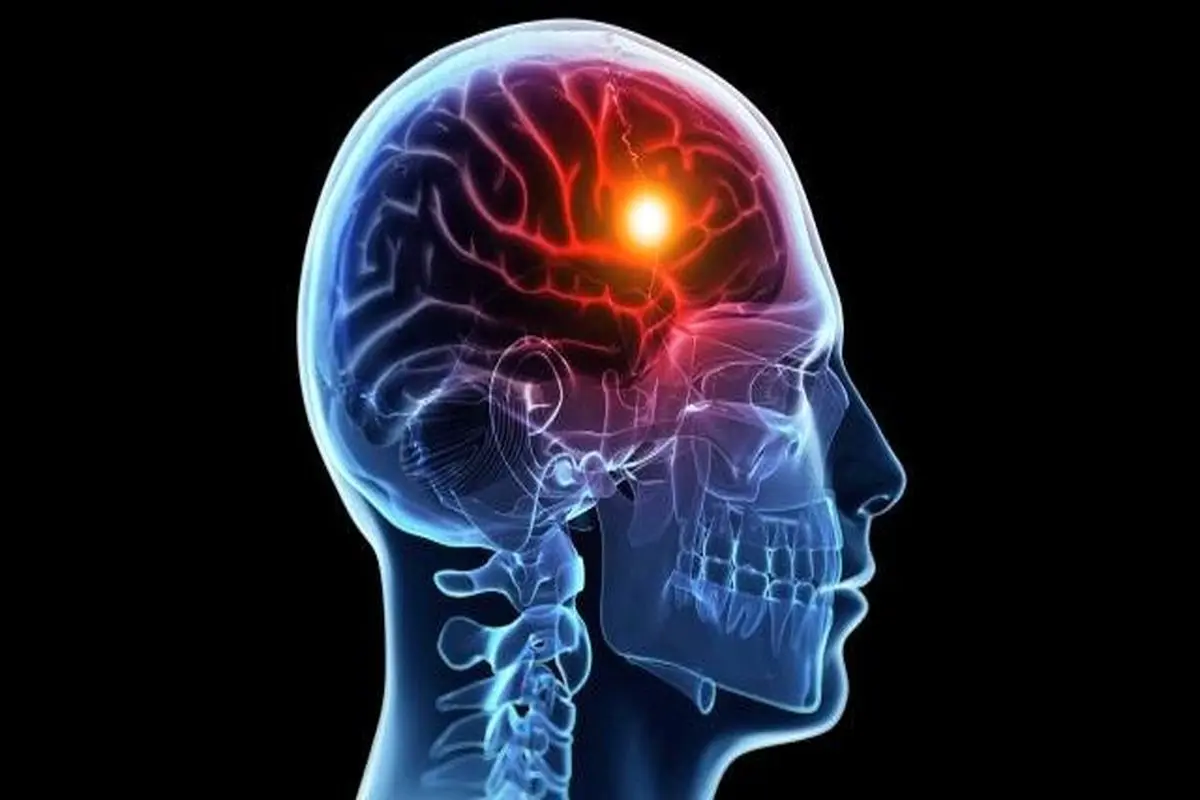 سکته مغزی چه علائمی دارد؟