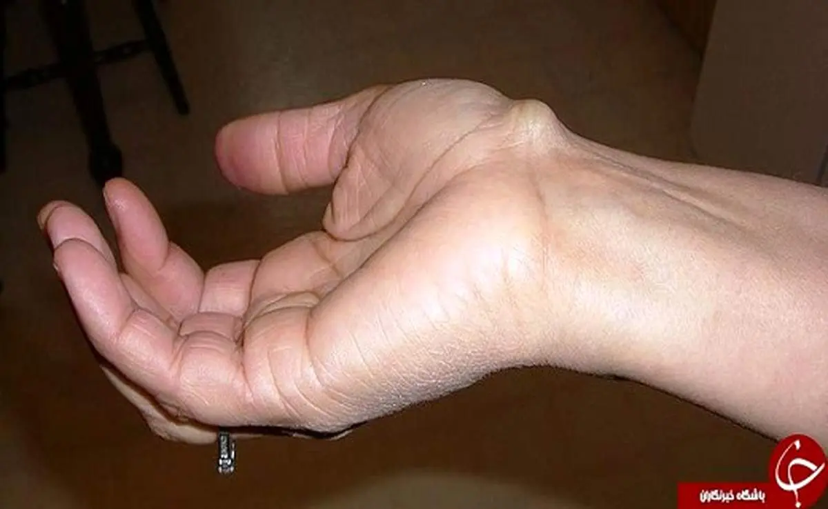 کیست‌های دردناکی که روی دست ظاهر می‌شوند!