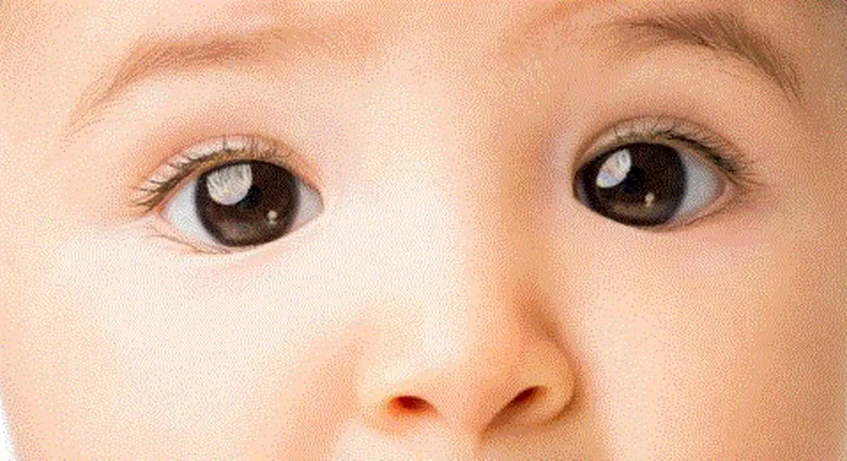 تمرین‌هایی برای کمک به رفع انحراف چشم