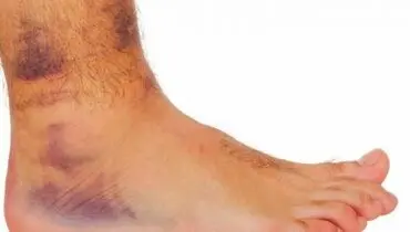هر آنچه باید درباره عفونت استخوان بدانید