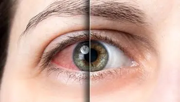 علت قرمزی چشم چیست ؟