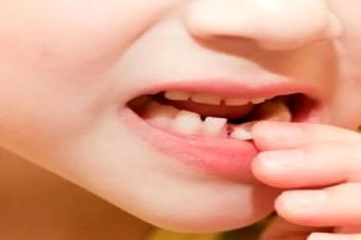 «چاقی» و «بهداشت دهان و دندان» مهمترین مشکلات سلامتی دانش‌آموزان