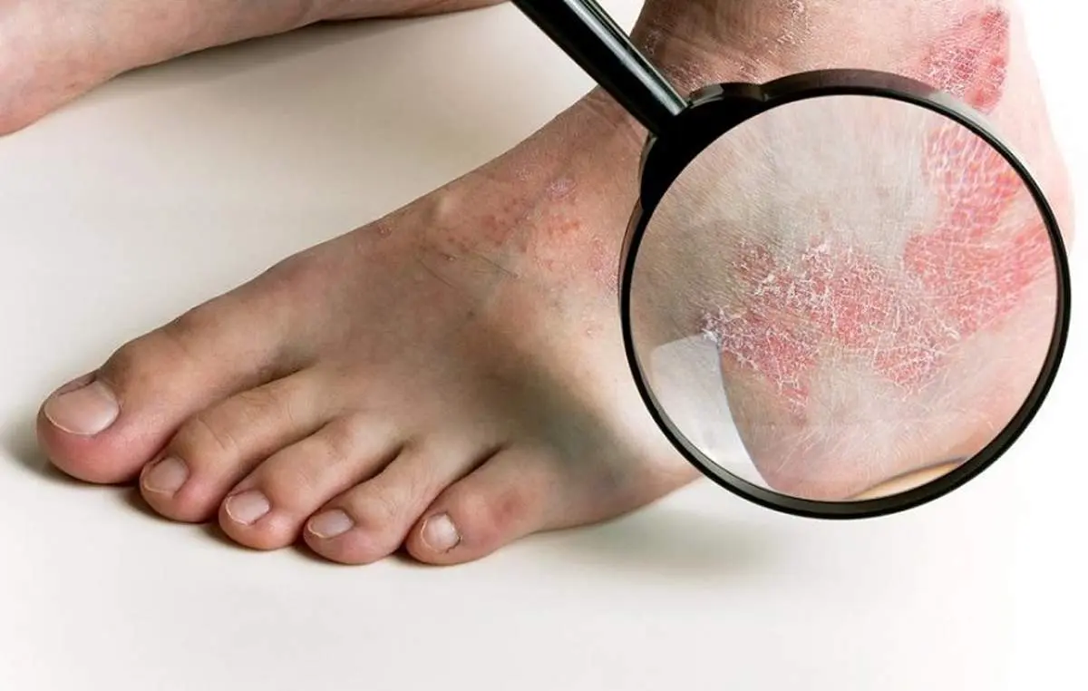 پسوریازیس چیست؟