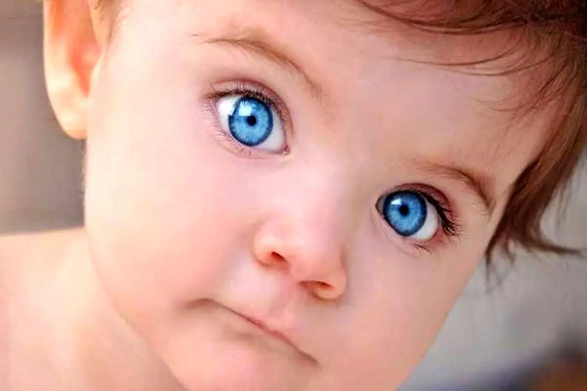 انحراف چشم در کودکان چگونه درمان می‌شود؟