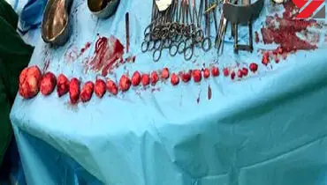 خروج ۲۷ توده از رحم دختر بندرعباسی+ عکس