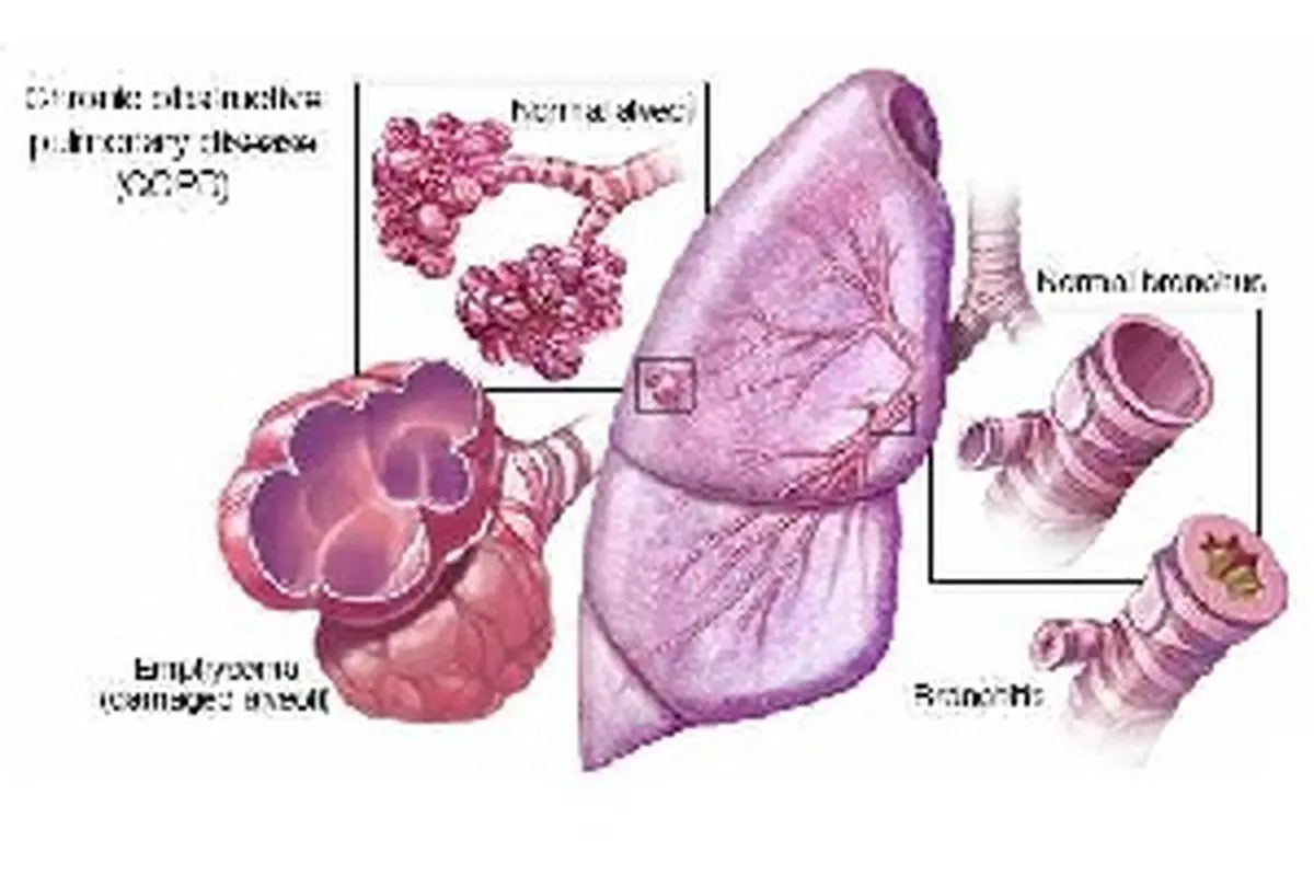 آیا بیماری انسداد مزمن ریه قابل درمان است؟ علت و درمان آن