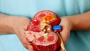 دفع سنگ کلیه با راهکار‌های خانگی