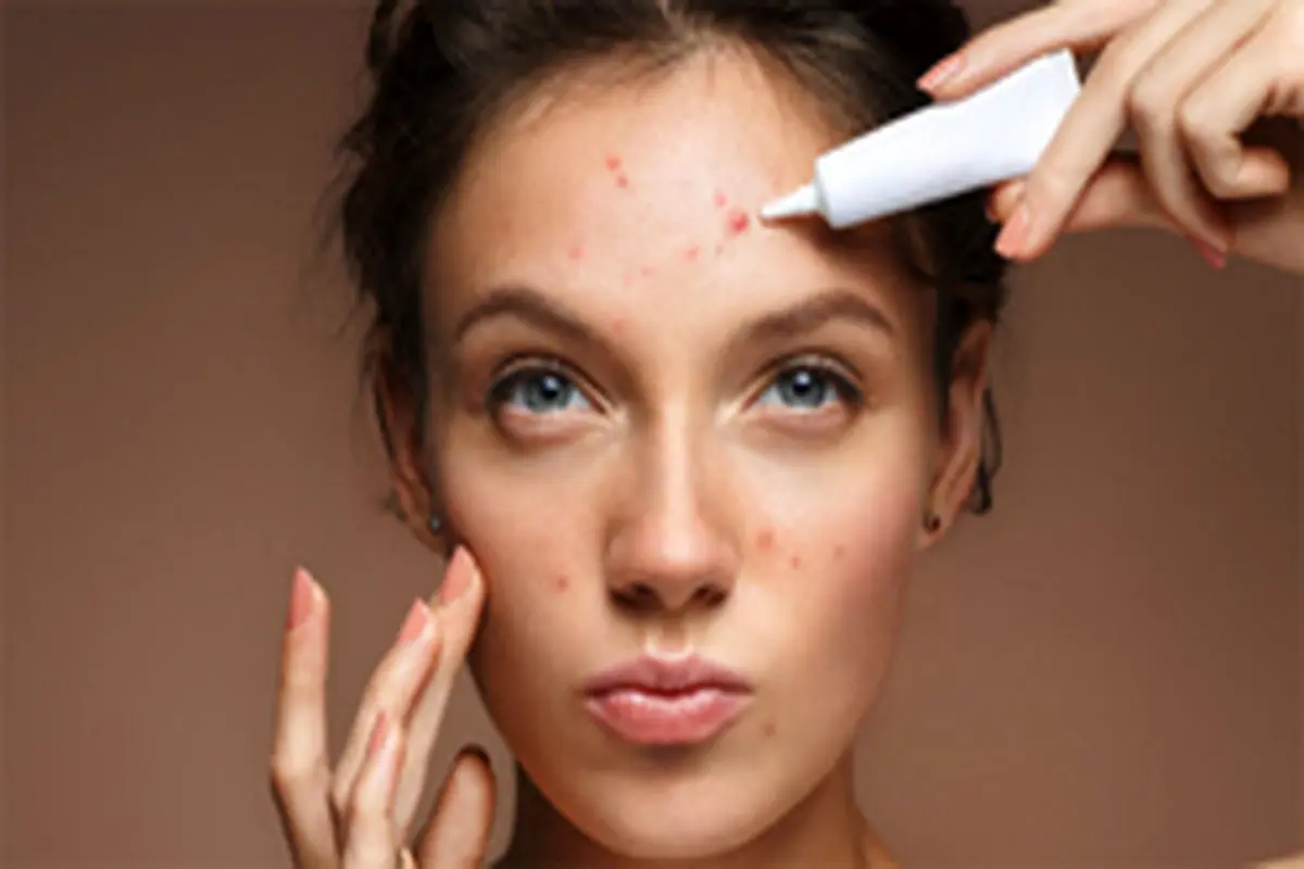 غذاهای چرب باعث "جوش صورت" میشوند؟