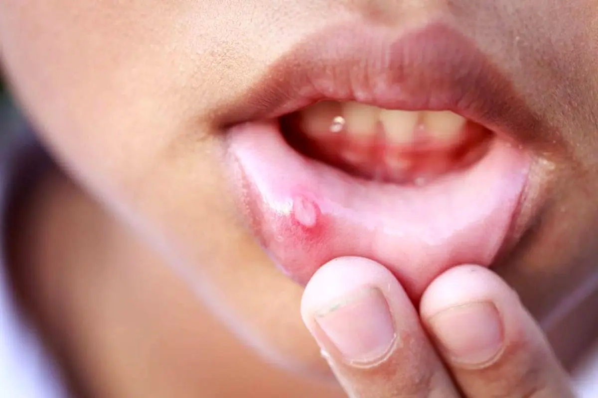 طب سنتی برای درمان آفت دهان چه توصیه‌هایی دارد؟