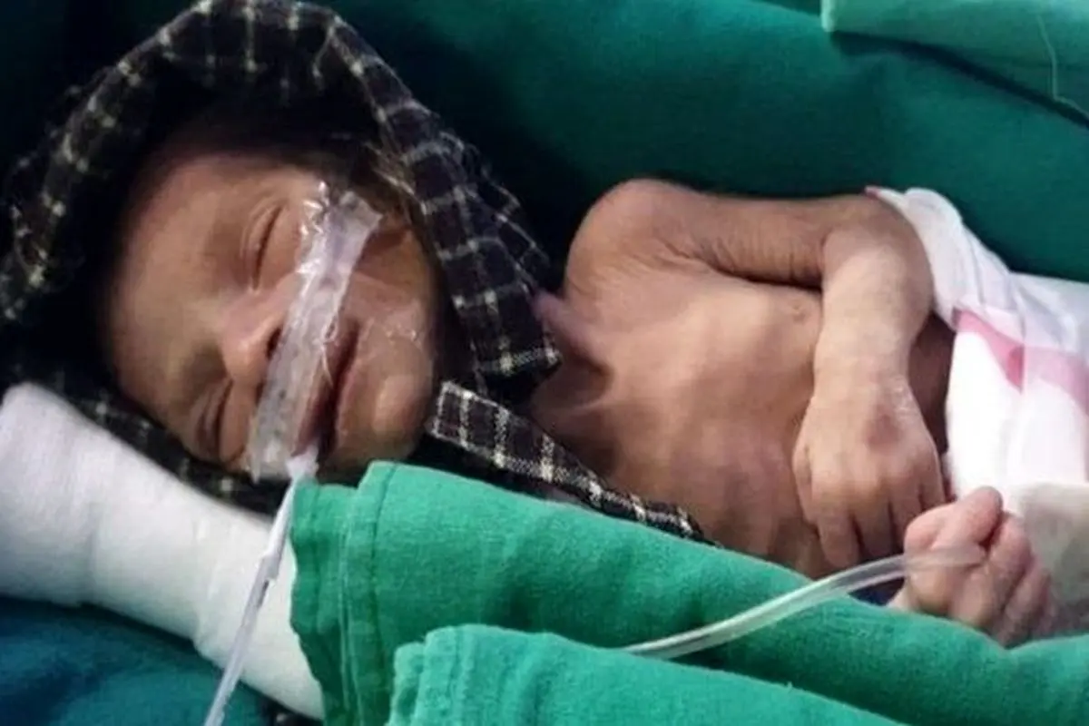 نوزاد دختر زنده به‌گور شده در هند، نجات یافت