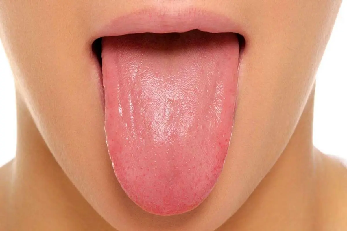نشانه‌های سرطان زبان