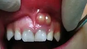 کیست دندان خود را سه سوته درمان کنید
