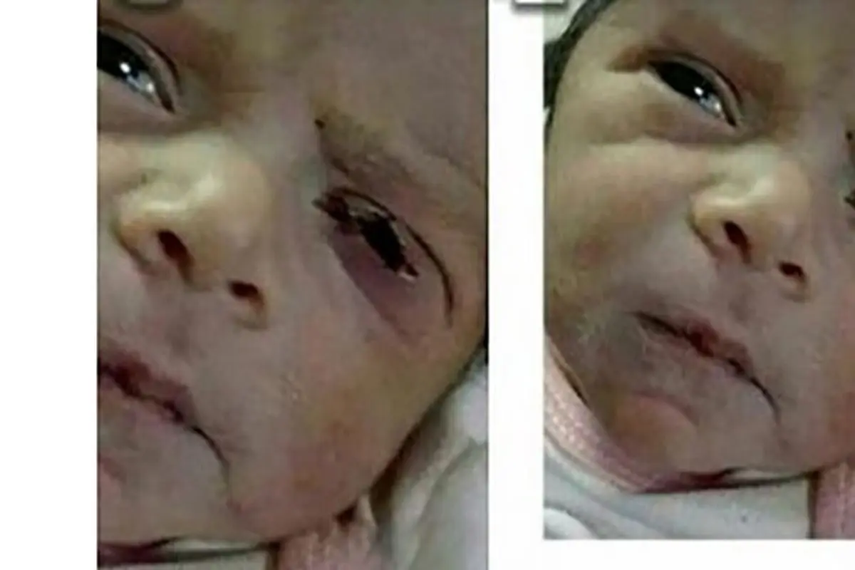 پرونده قصور پزشکی در حادثه پارگی پلک نوزاد نطنزی به کجا رسید؟+ عکس