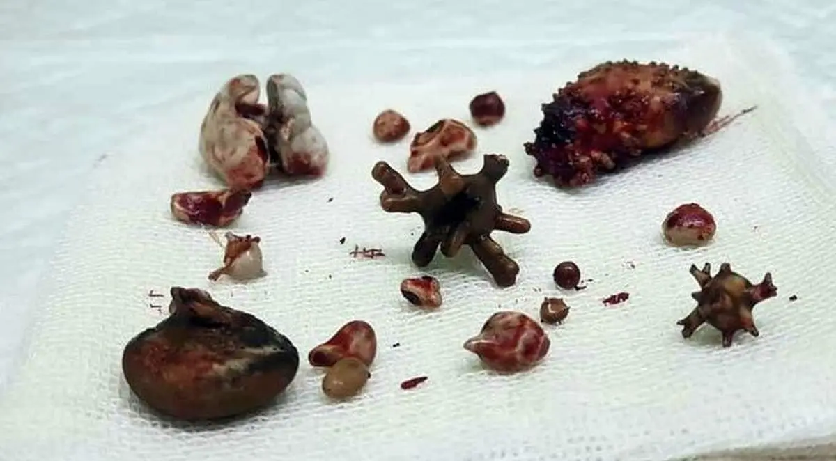 ۳۰ سنگ عجیب و غریب در بدن مرد چابهاری جا خوش کرده بود+ عکس