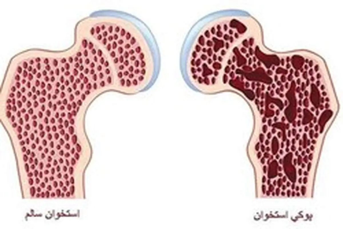 پوکی استخوان و مشکلات ناشی از آن