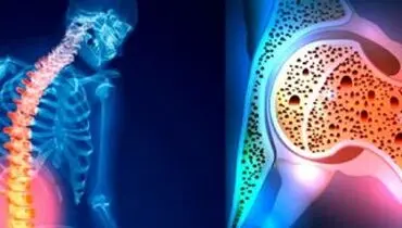 پوکی استخوان در زنان بیشتر از مردان