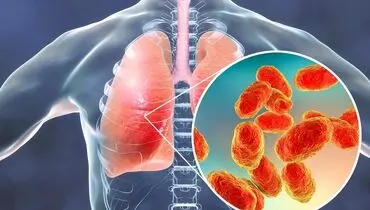 علائم این بیماری مرگبار با تب و لرز، سرفه و تنگی نفس آغاز می‌شود