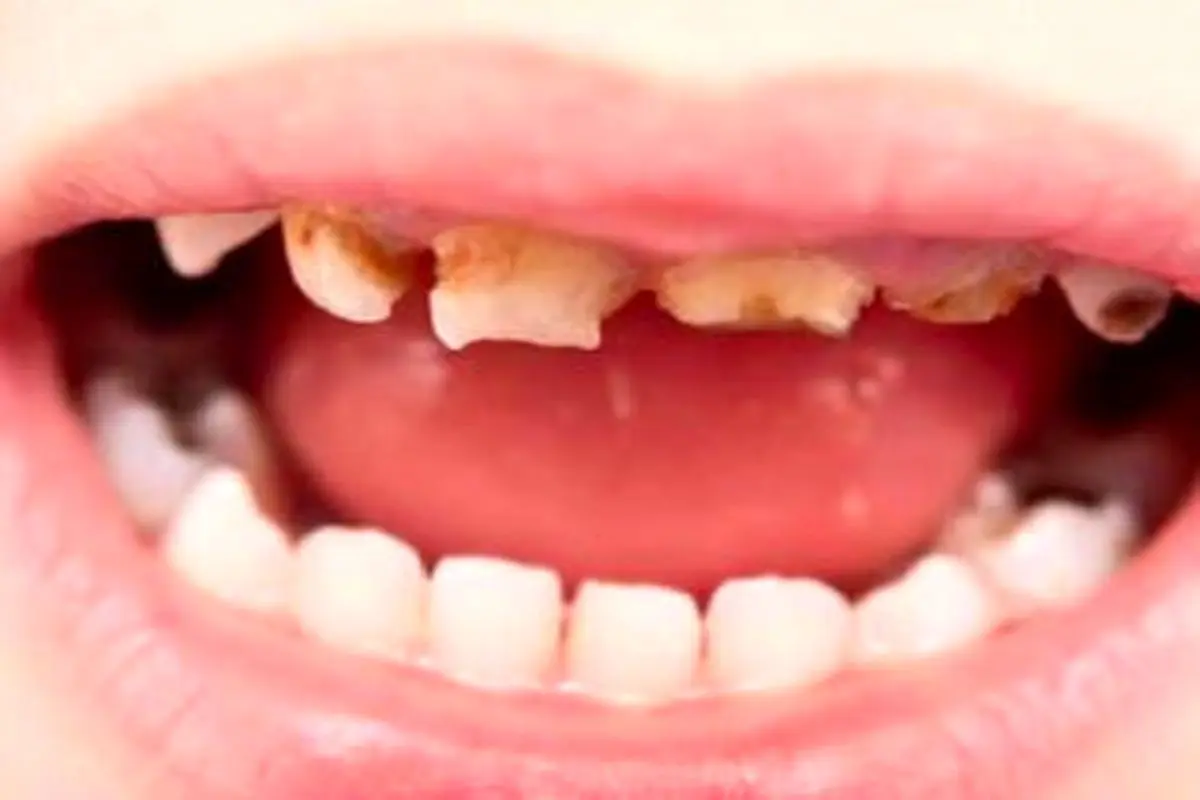 اختلالات ساختاری دندان‌ها و دلایل آن‌ها