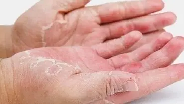 آشنایی با راه‌های درمان اگزما