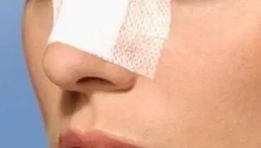 حداقل سن برای جراحی زیبایی «بینی»
