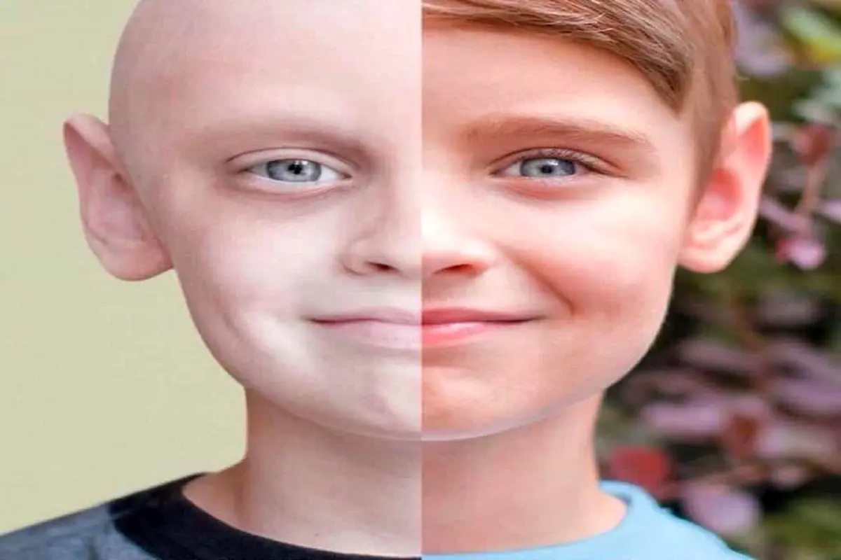 کدام کودکان بیشتر به سرطان مبتلا می‌شوند؟