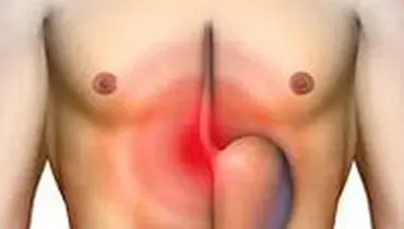 چرا معده ریفلاکس می‌گیرد؟
