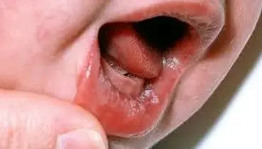 آفت دهان ناشی از چیست؟