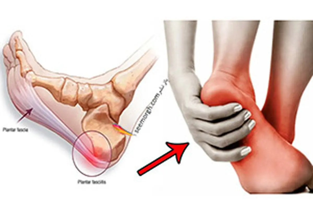 پلنتار فاسیتیس یا درد کف پا چیست و چطور درمان می‌شود؟